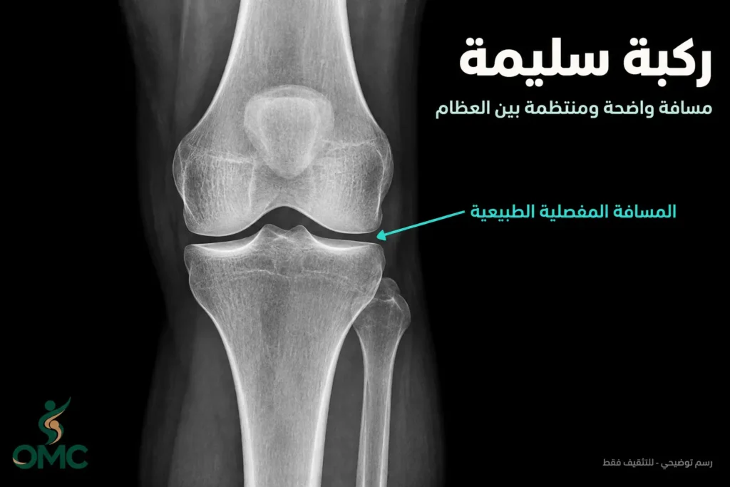 شكل الركبة السليمة في الأشعة شكل الركبة السليمة في الأشعة