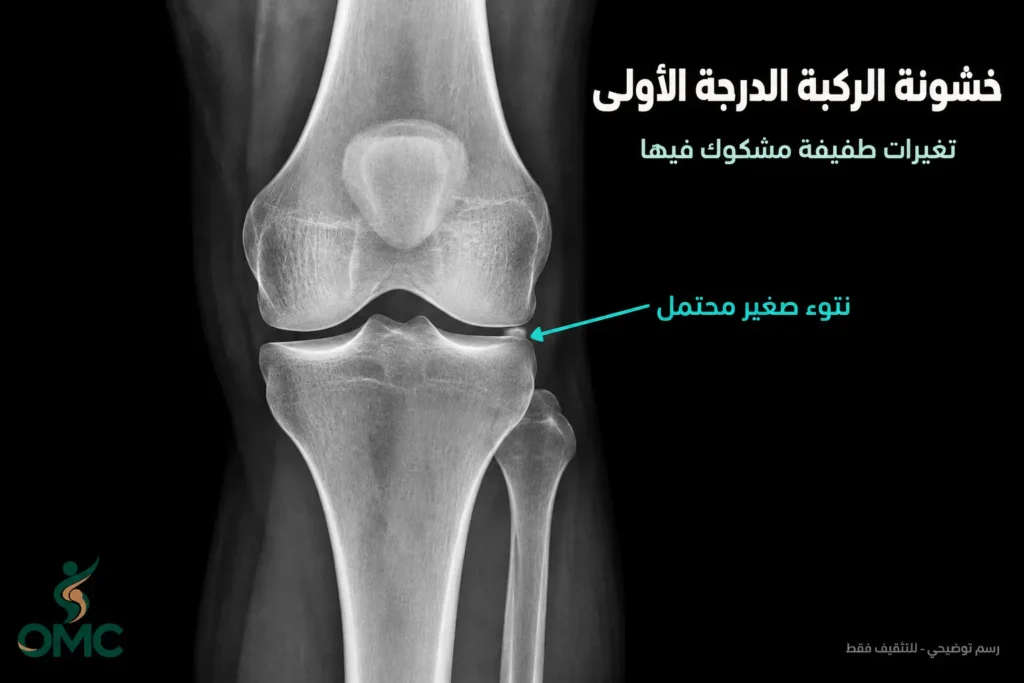 شكل خشونة الركبة الدرجة الأولى في الأشعة شكل خشونة الركبة الدرجة الأولى في الأشعة