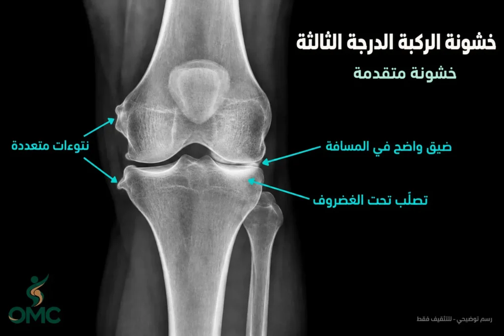 شكل خشونة الركبة الدرجة الثالثة في الأشعة شكل خشونة الركبة الدرجة الثالثة في الأشعة
