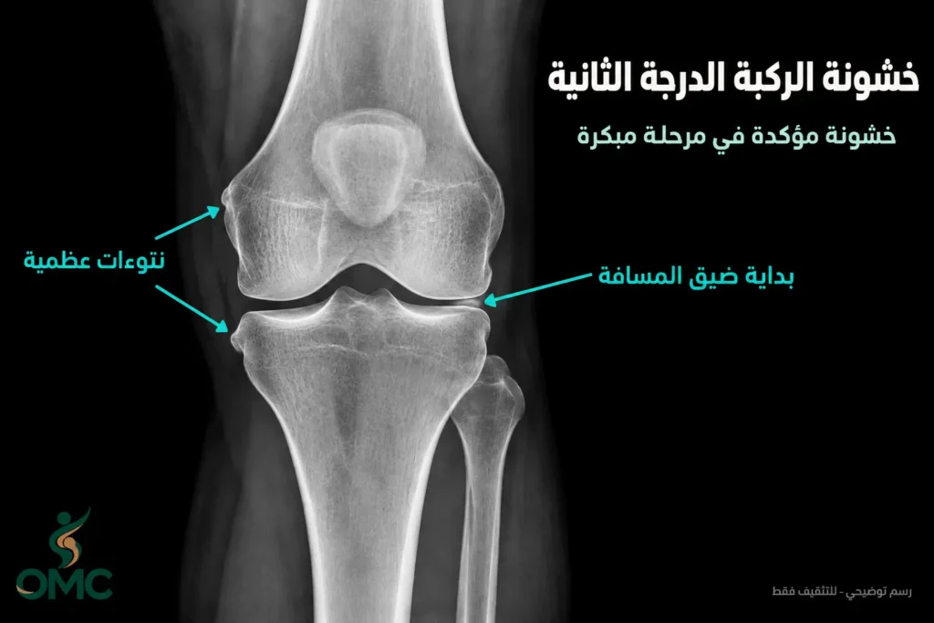 شكل خشونة الركبة الدرجة الثانية في الأشعة