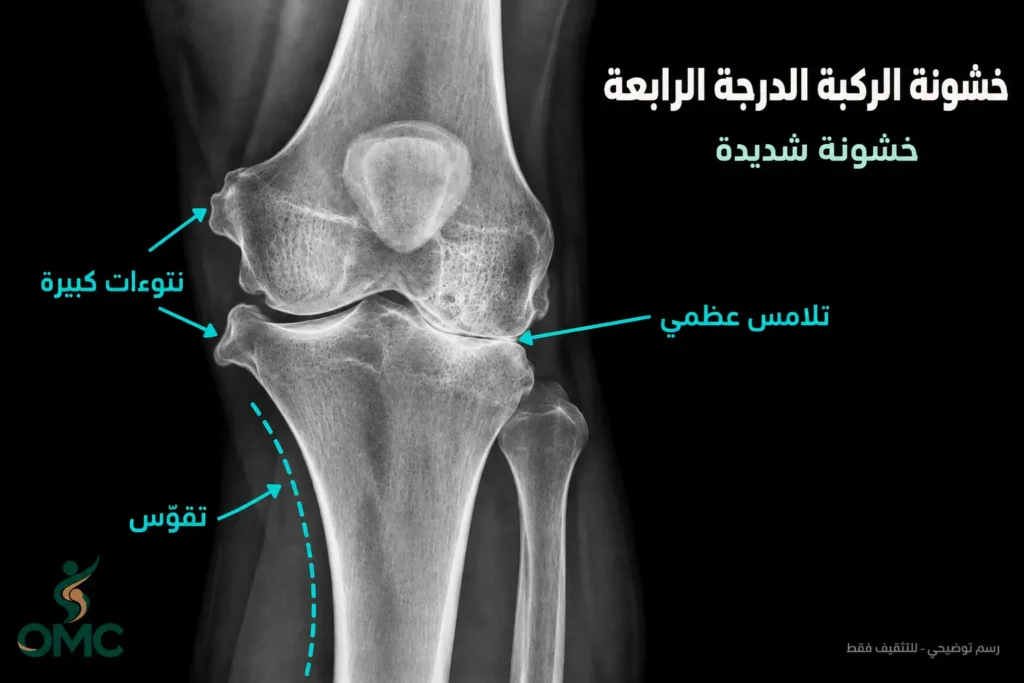 شكل خشونة الركبة الدرجة الرابعة في الأشعة شكل خشونة الركبة الدرجة الرابعة في الأشعة